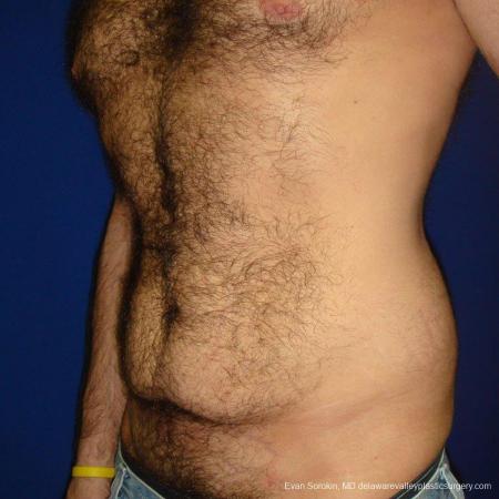 Philadelphia Abdominoplasty 9468 - Before Image 4