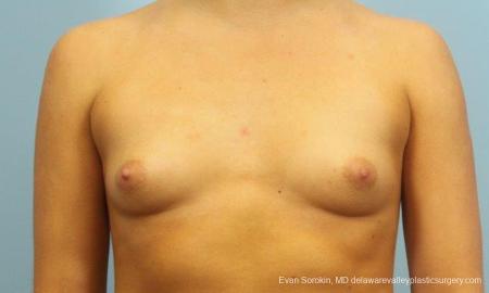 Philadelphia Breast Augmentation 9183 - Before Image 1