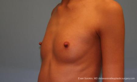 Philadelphia Breast Augmentation 9377 - Before Image 4