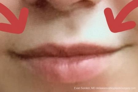 Lip Filler: Patient 19 - Before and After Image 2