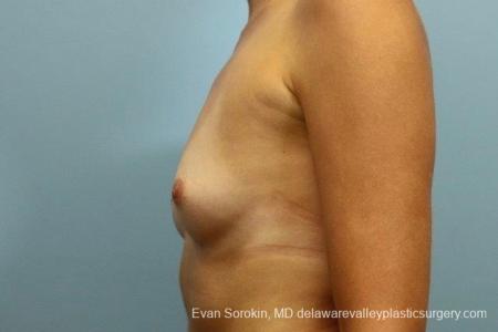 Philadelphia Breast Augmentation 8764 - Before and After Image 5