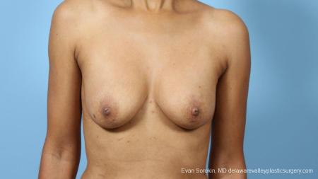 Philadelphia Breast Augmentation 9288 - Before Image 1
