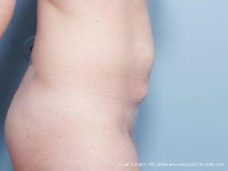 Philadelphia Abdominoplasty 9476 - Before Image 3