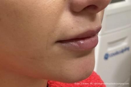 Lip Augmentation: Patient 9 - Before Image 1
