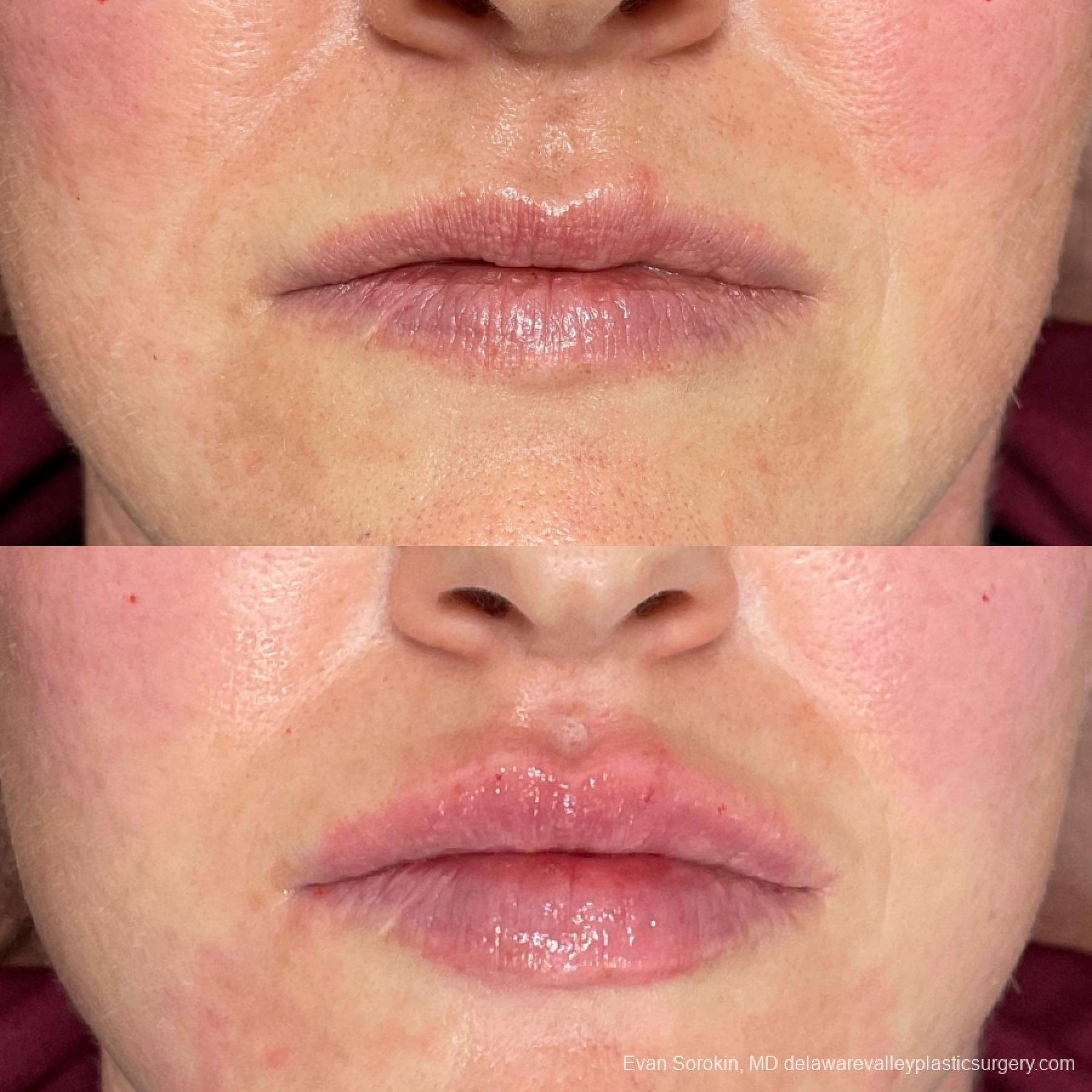 Lip Augmentation: Patient 46 - Before and After 1