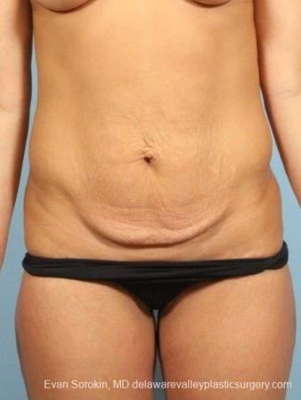 Philadelphia Abdominoplasty 8698 - Before Image 1