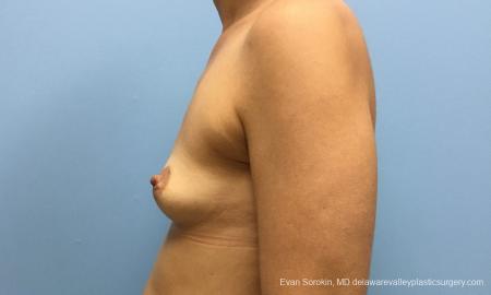Philadelphia Breast Augmentation 12519 - Before and After Image 5
