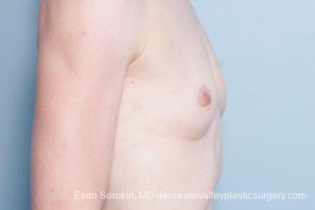 Philadelphia Breast Augmentation 9169 - Before Image 3
