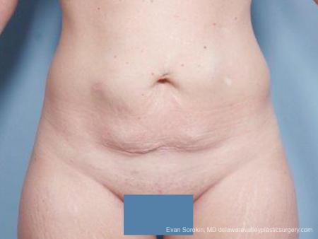 Philadelphia Abdominoplasty 9476 - Before Image 1