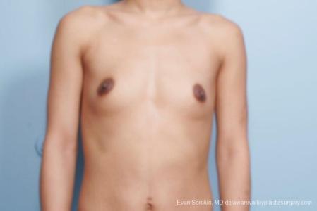 Philadelphia Breast Augmentation 9106 - Before Image 1