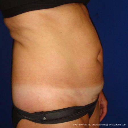 Philadelphia Liposuction 9488 - Before Image 3