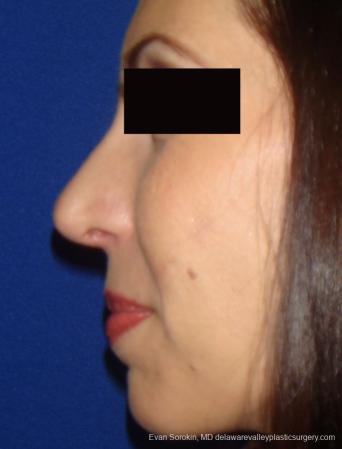 Rhinoplasty: Patient 1 - After Image 1