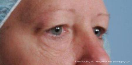 Philadelphia Blepharoplasty 9314 - Before and After Image 2