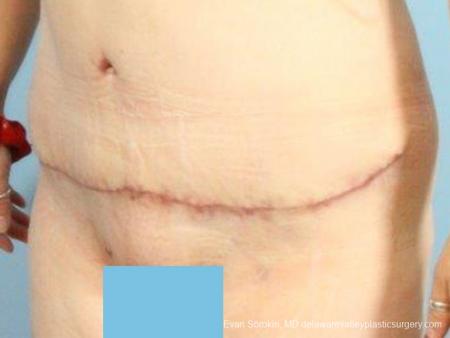 Philadelphia Abdominoplasty 9467 - After Image 4
