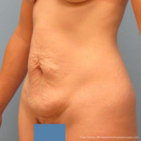 Philadelphia Abdominoplasty 9465 - Before Image 4