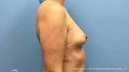 Philadelphia Breast Augmentation 13181 - Before Image 3