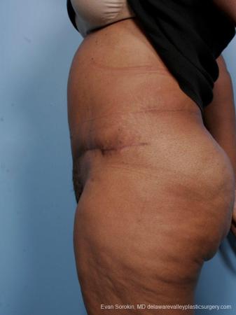 Philadelphia Abdominoplasty 9461 - After Image 5