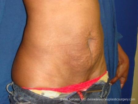 Philadelphia Abdominoplasty 8707 - Before and After Image 3