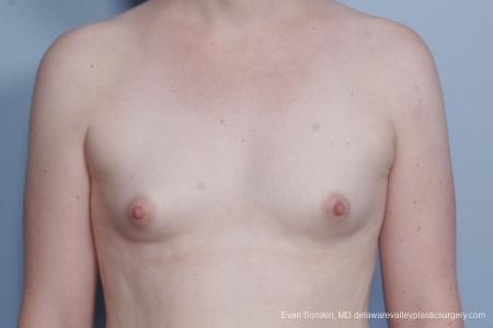 Philadelphia Top Surgery Male to Female 8642 - Before Image 1