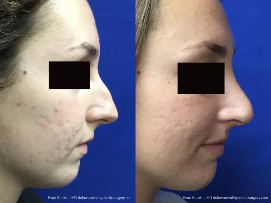 Rhinoplasty: Patient 2 - Before and After  