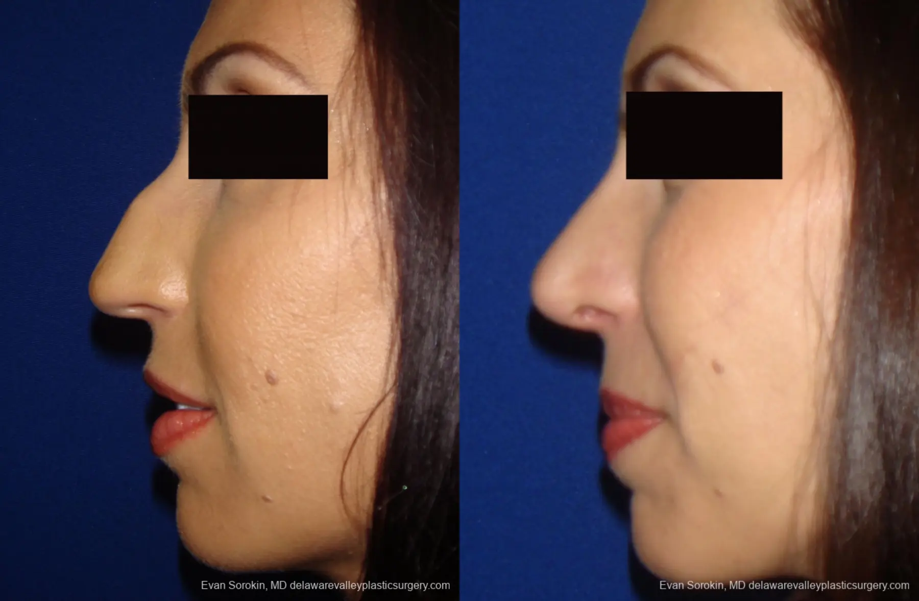 Rhinoplasty: Patient 1 - Before and After 1