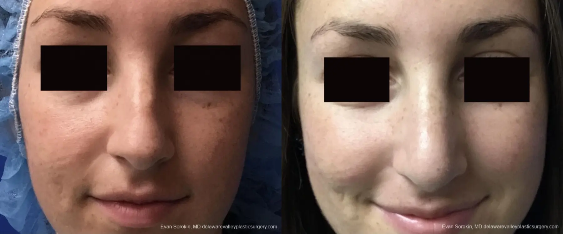 Rhinoplasty: Patient 2 - Before and After 2