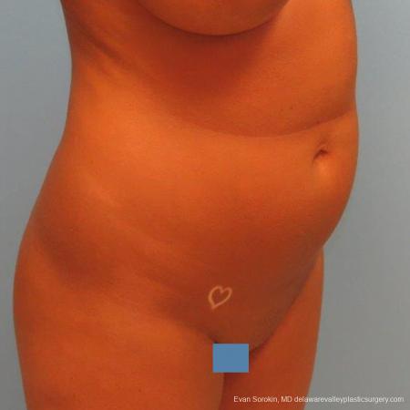 Philadelphia Liposuction 9483 - Before and After Image 4