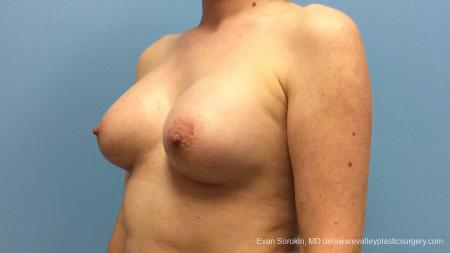 Philadelphia Breast Augmentation 13181 - After Image 4