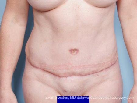 Philadelphia Abdominoplasty 9315 - After 1