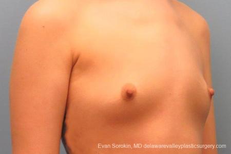 Philadelphia Breast Augmentation 10113 - Before Image 2