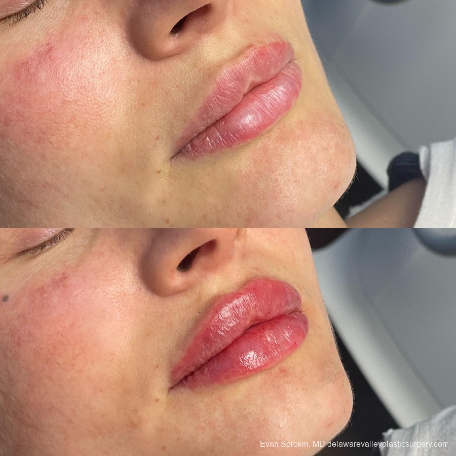 Lip Augmentation: Patient 62 - Before and After 2