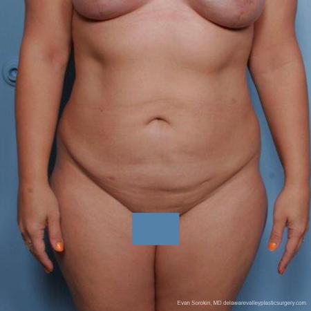 Philadelphia Liposuction 9481 - After Image 1