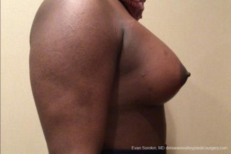 Top Surgery - Male To Female: Patient 2 - After Image 2