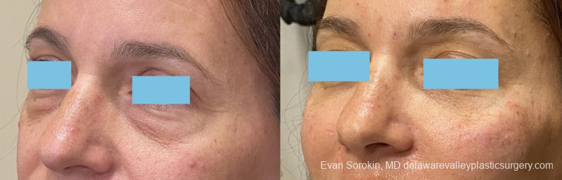 Fillers: Patient 41 - Before and After 1