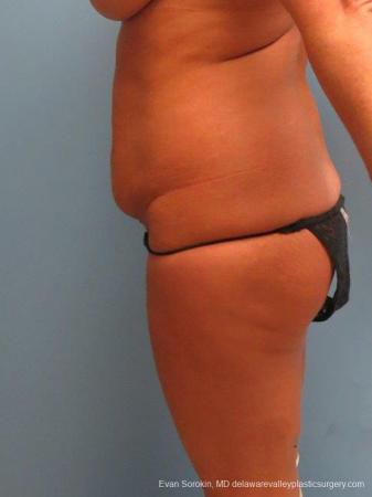 Philadelphia Abdominoplasty 9463 - Before and After Image 5