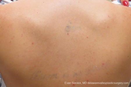 Philadelphia Tattoo Removal 8645 - After Image 1