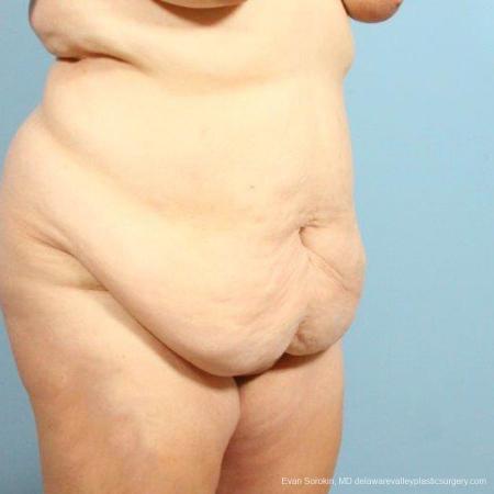 Philadelphia Abdominoplasty 9466 - Before Image 2