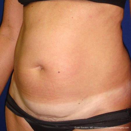 Philadelphia Liposuction 9488 - Before Image 2