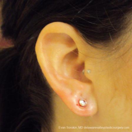 Philadelphia Earlobe Surgery 9384 - After Image 3