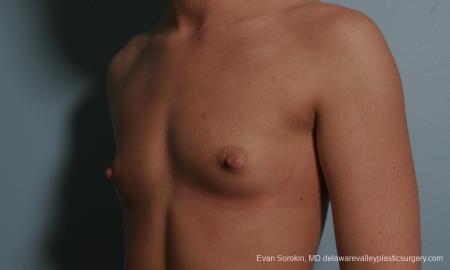 Philadelphia Breast Augmentation 8664 - Before Image 4