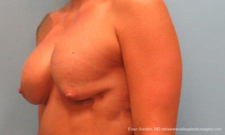 Philadelphia Breast Lift and Augmentation 9370 - Before Image 2