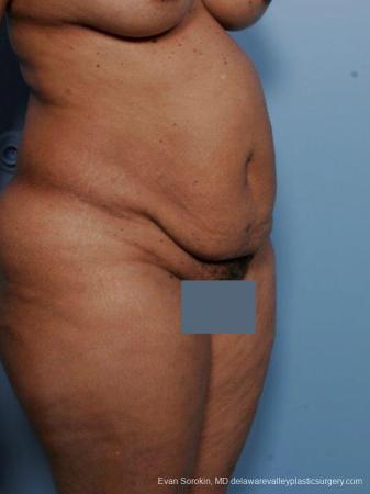 Philadelphia Abdominoplasty 9461 - Before Image 2