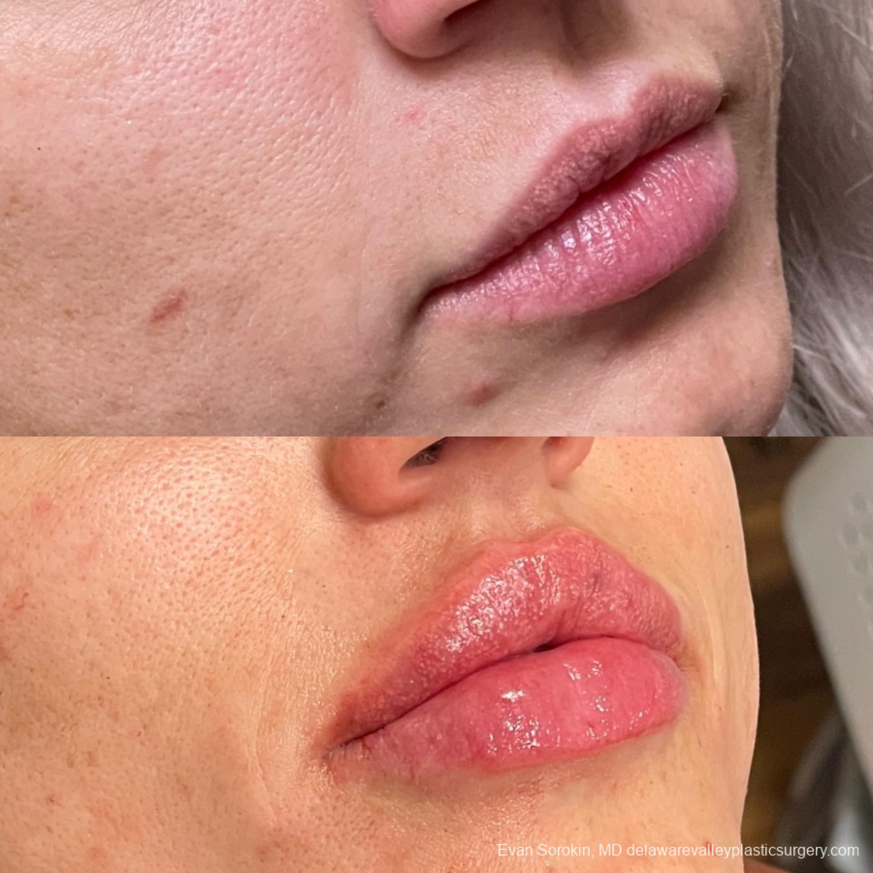 Lip Augmentation: Patient 58 - Before and After 2