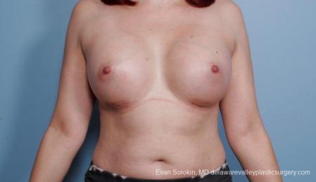 Breast Augmentation: Patient 54 - After Image 1