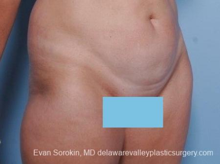Philadelphia Abdominoplasty 8682 - Before Image 2