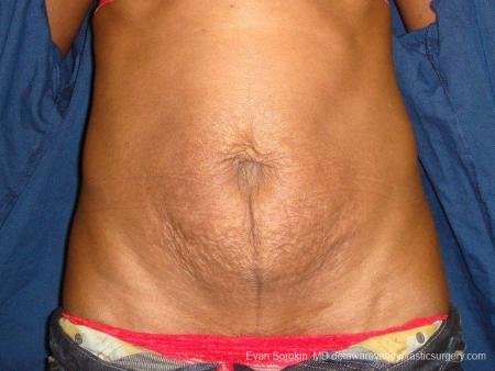 Philadelphia Abdominoplasty 8707 - Before Image 1