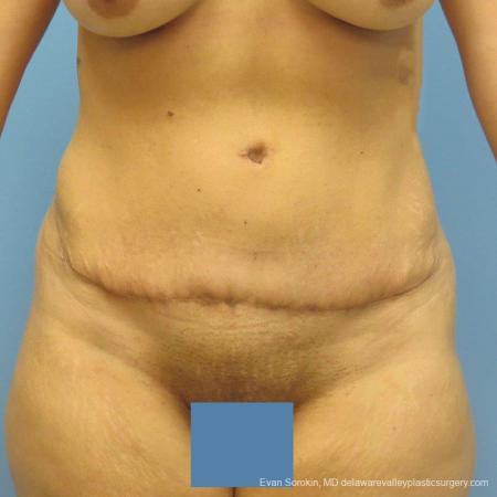 Philadelphia Abdominoplasty 9478 - After Image 1