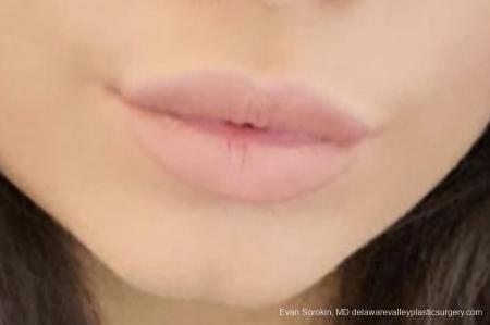 Lip Filler: Patient 19 - After Image 1