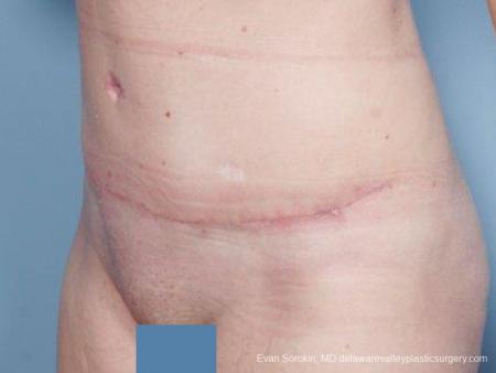 Philadelphia Abdominoplasty 9476 - After Image 4