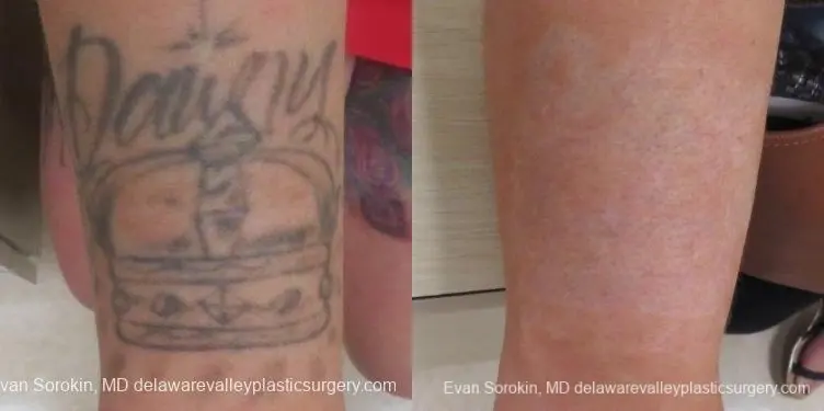 Philadelphia Tattoo Removal 8647 - Before and After 1